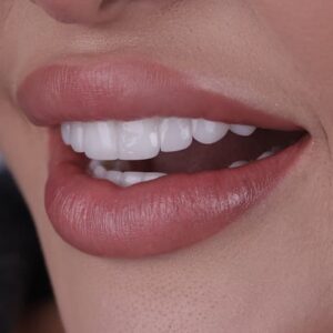 Porcelain Veneer Deposit Pay